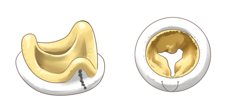 最常用的生物材料有牛心包瓣和猪的主动脉瓣两种,两种瓣膜的使用寿命