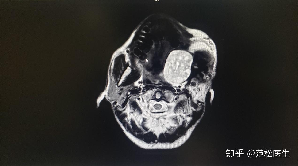 頜面腫物已經非常大,而且他們已經輾轉多家醫院,鑑於患者的腫瘤巨大