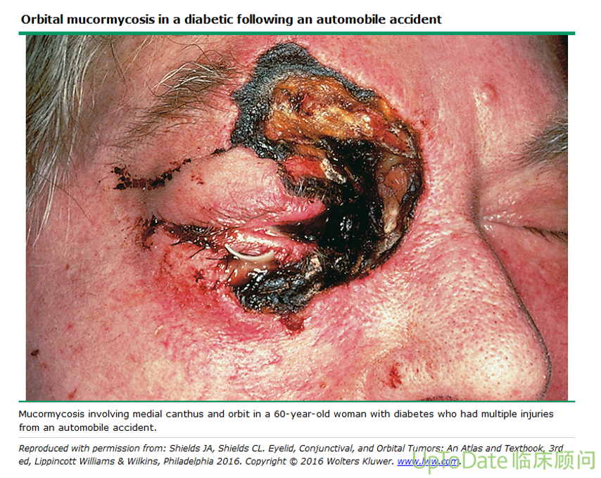 印度多个邦爆发新冠康复者感染毛霉菌病例,继"黑色霉菌"和"白色霉菌"