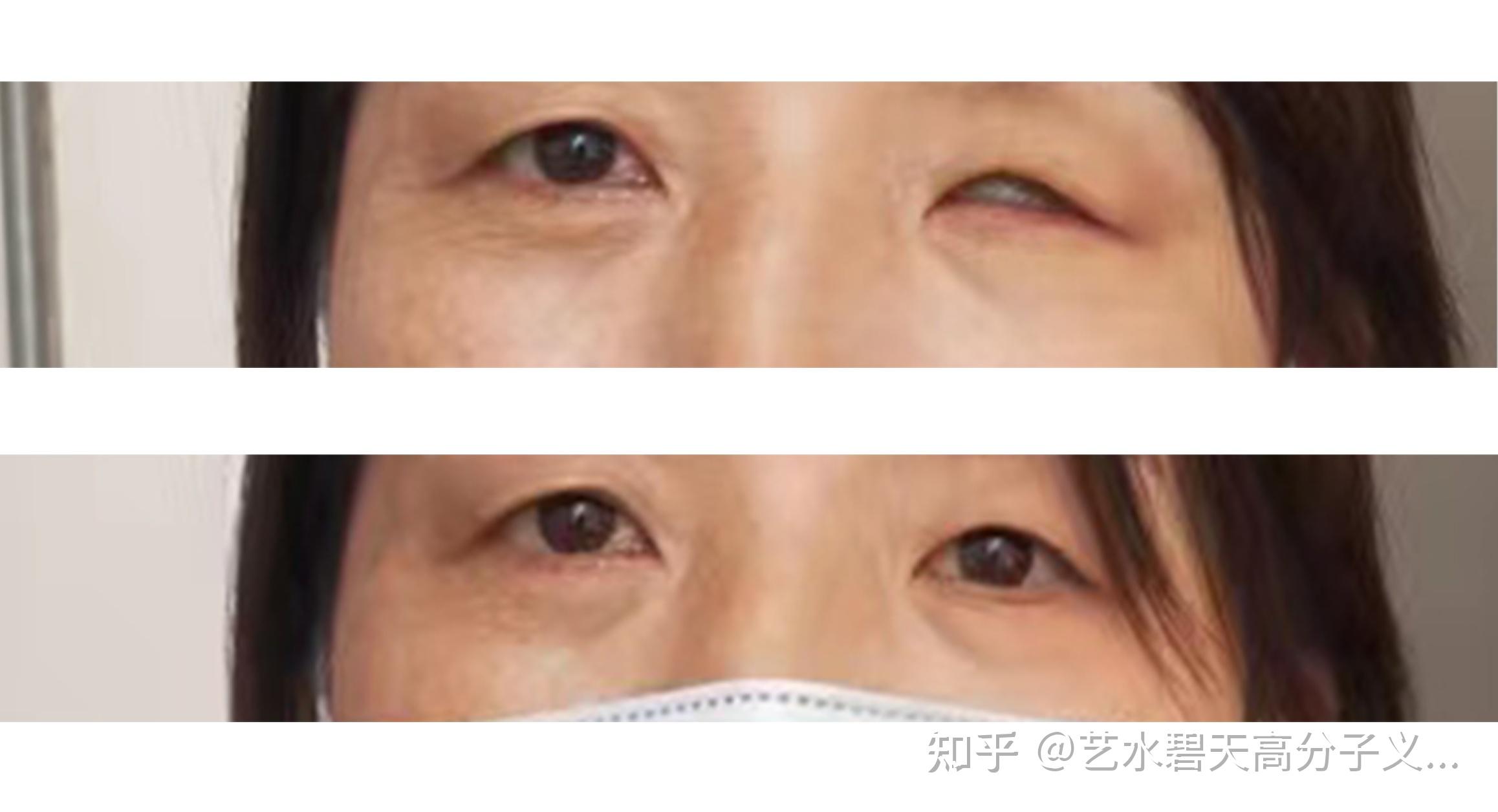 为什么每片义眼的形状都不相同该怎样判断哪种义眼更适合佩戴呢 - 知乎