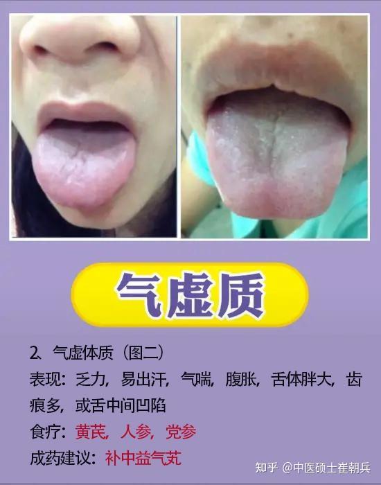 分享9种体质舌象,让老中医教你辨证,后面给你解决方法 - 知乎