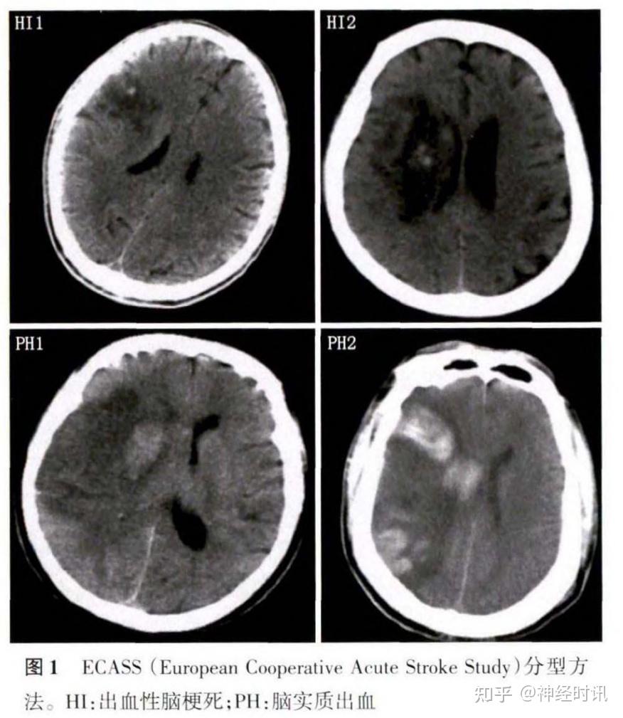 急性脑梗死图片