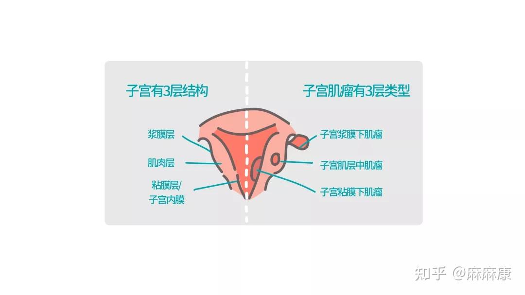 2,子宫肌瘤