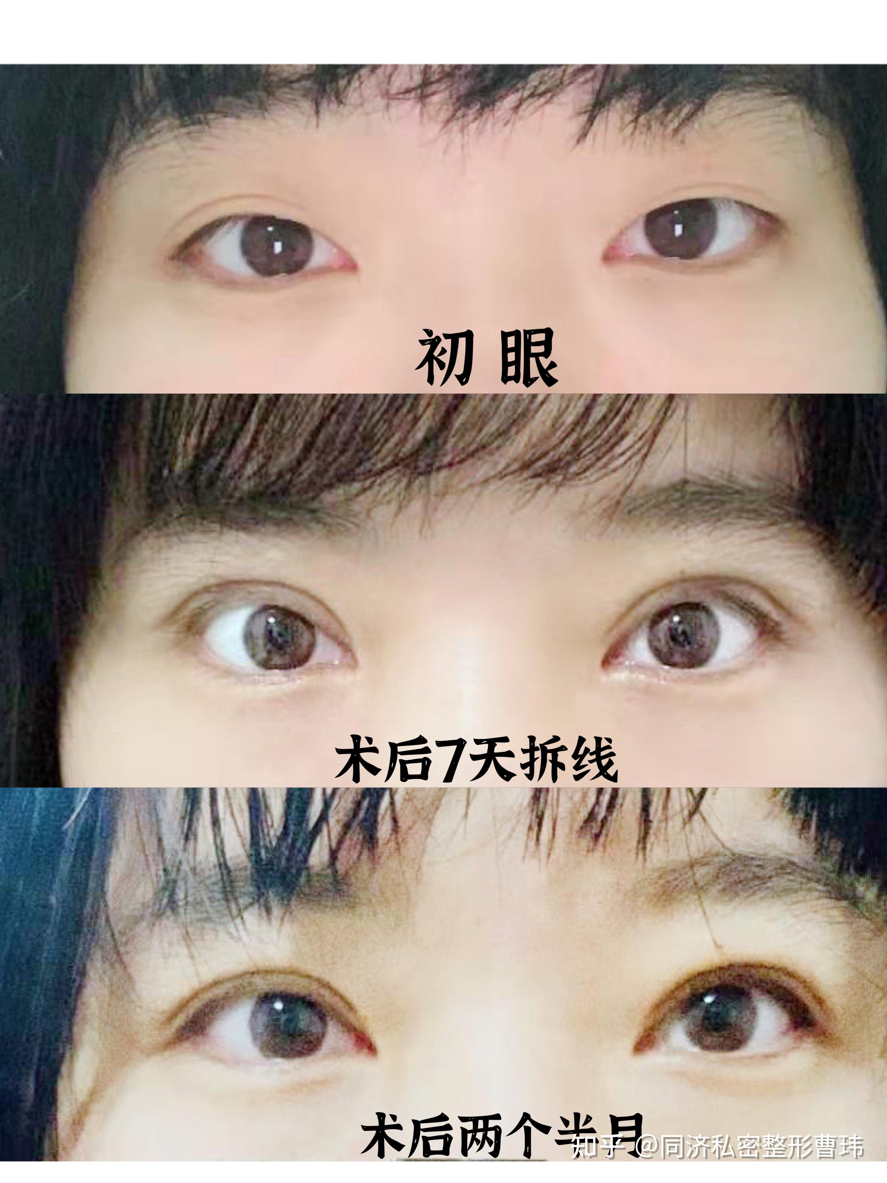 青岛5S双眼皮真实案例分享，术前术后效果对比 - 青岛新闻网