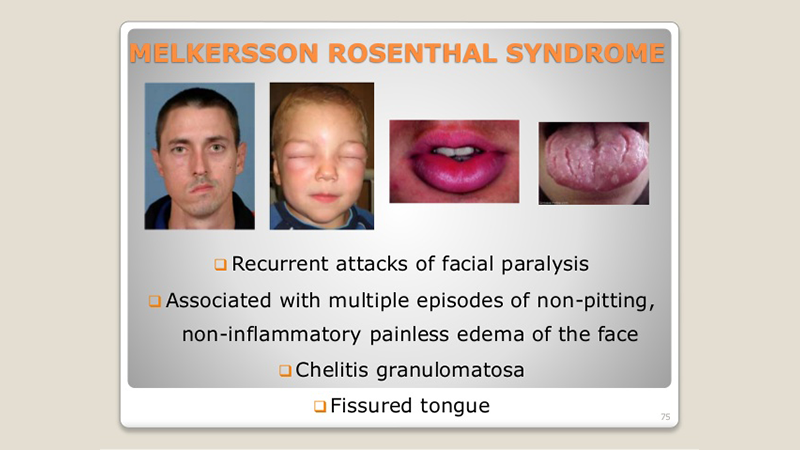 面瘫规范诊疗指南 说起面瘫,大家都知道面瘫发病主要一类是贝尔麻痹