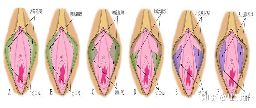 如果你的私处让你有这几点感受,则证明小阴唇太过肥大! - 知乎