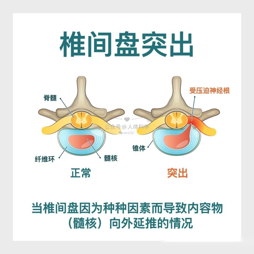 人体科学 椎间盘突出会怎样