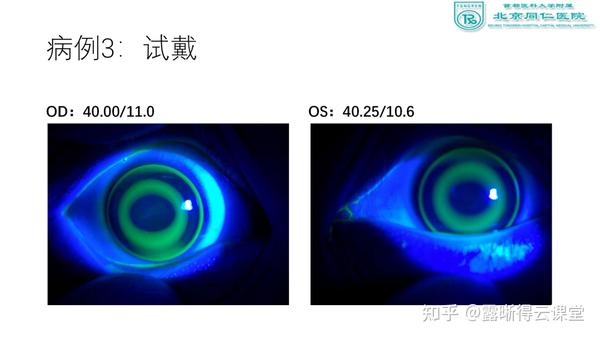 角膜地形图解读及露晰得塑形镜验配要点（文字版） - 知乎
