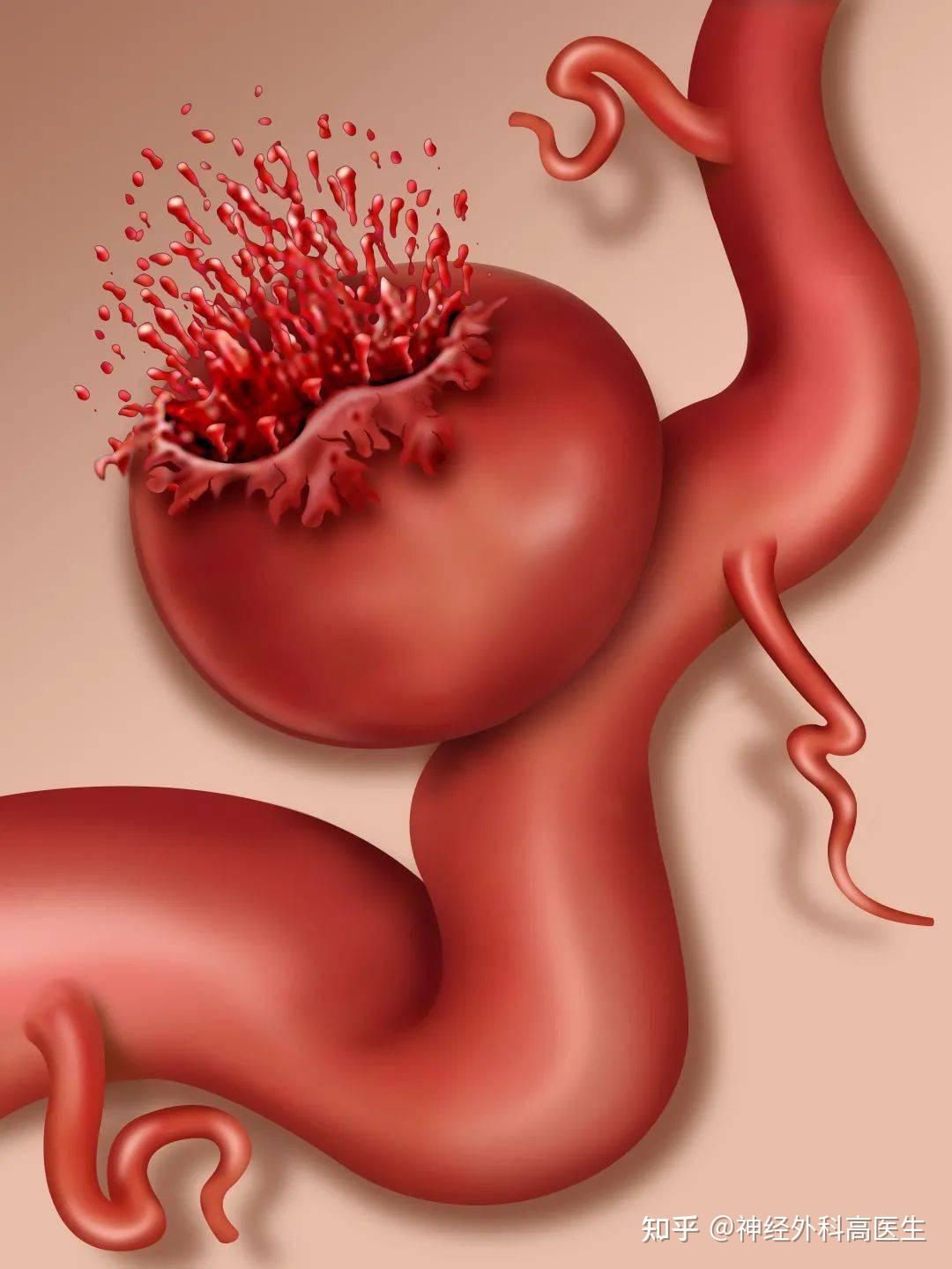 脑急性血管瘤形成的原因