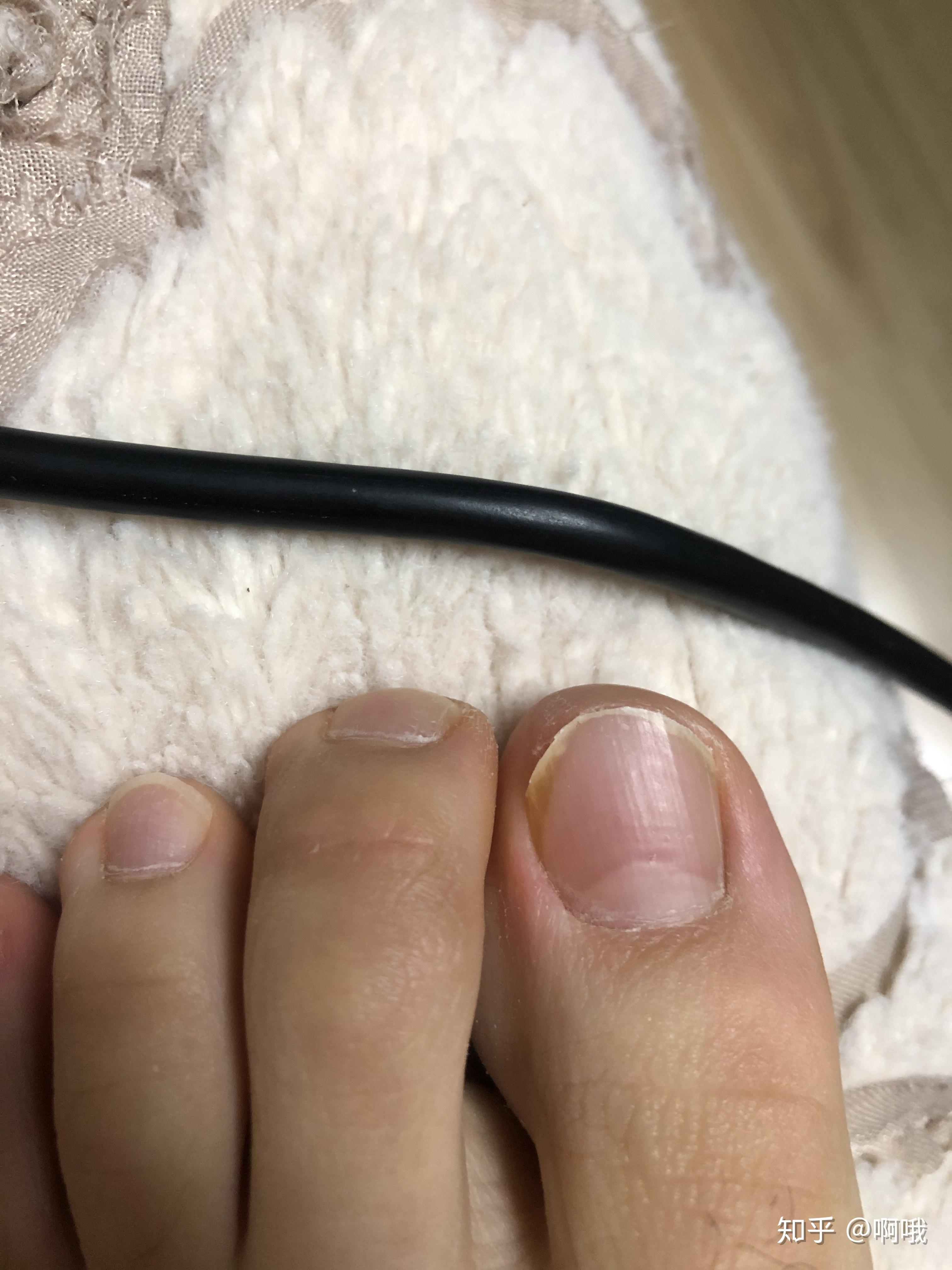 这是甲床萎缩了嘛