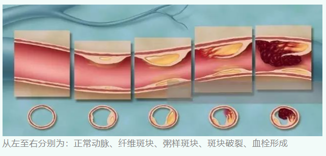血栓和斑块是一回事吗?看完这篇你就懂了 - 知乎