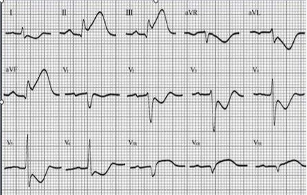 心電圖檢查出心肌梗死醫生又說正常到底是怎麼回事