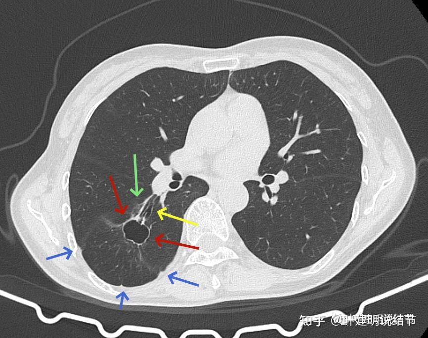 問診分析又是囊腔型病灶又是隨訪多年又是專家意見不一囊腔型肺癌有些