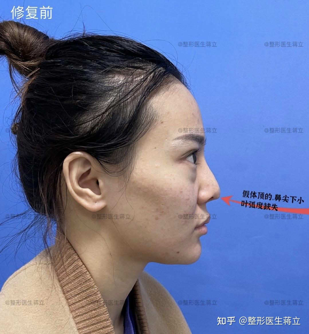 鼻 | 日本を代表する美容健康再生医療のクリニック｜ビアンカ銀座