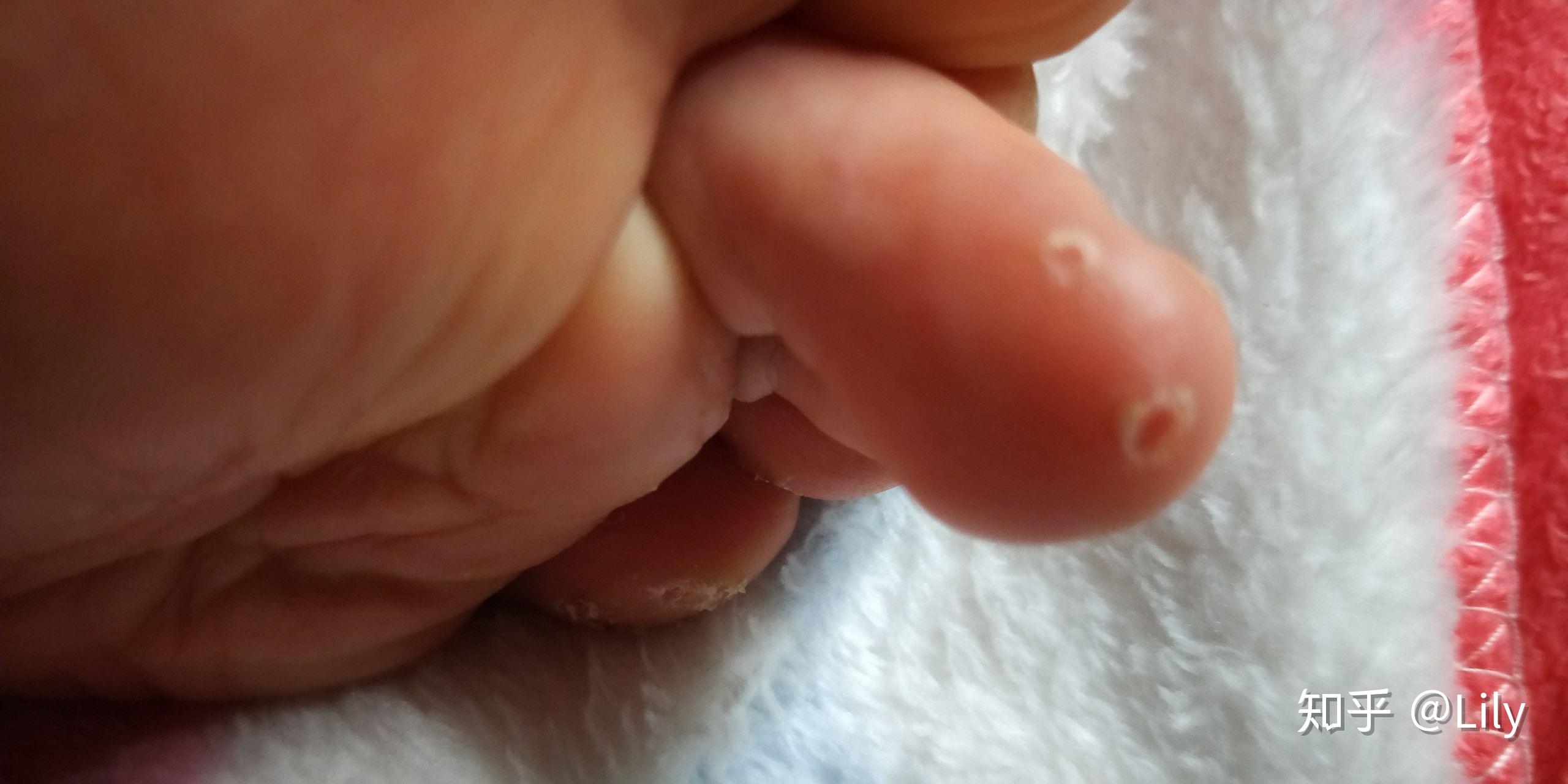 小护士的跖疣大作战03