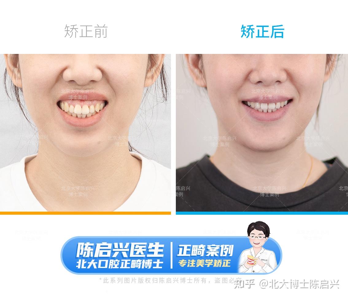 北京牙齿矫正吕杰医生案例分享 | 上颌骨性前突 - 哔哩哔哩