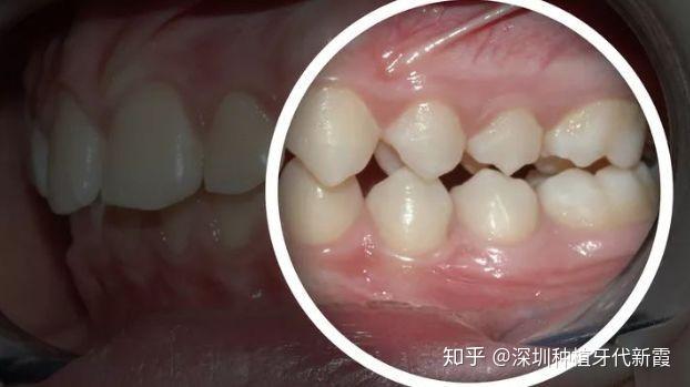 和颊黏膜的摩擦并不疼,而是在腮帮子上留下了两条角化白线,叫颊白线