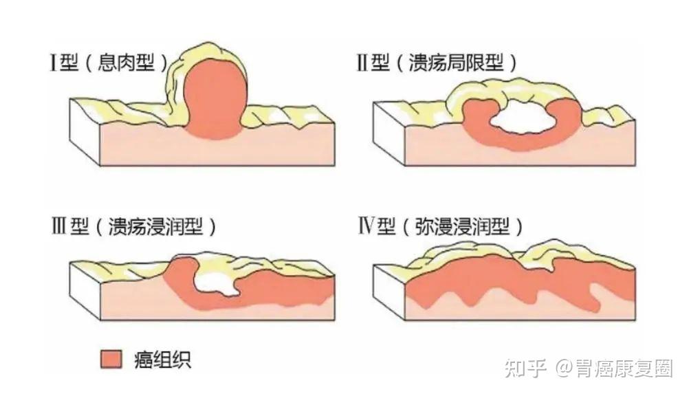 胃癌病理报告=有字天书？别急，一文教你看懂 - 知乎