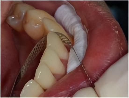 正畸医生须知邻面去釉工具与临床操作详解适应症禁忌症去釉量注意事项