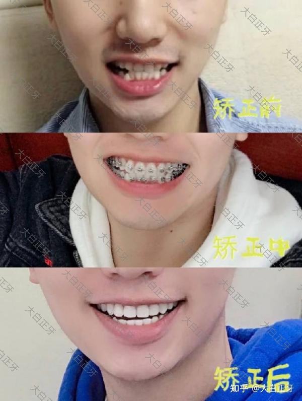 西安市大医院牙齿天包地矫正大概多少钱?