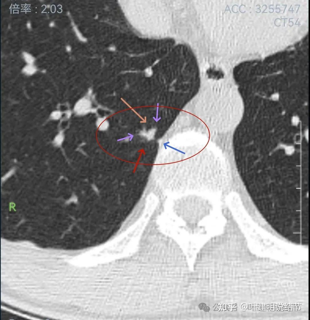 单挑省市两级不服输这个随访3年多省市两级都考虑良性的肺结节我认为
