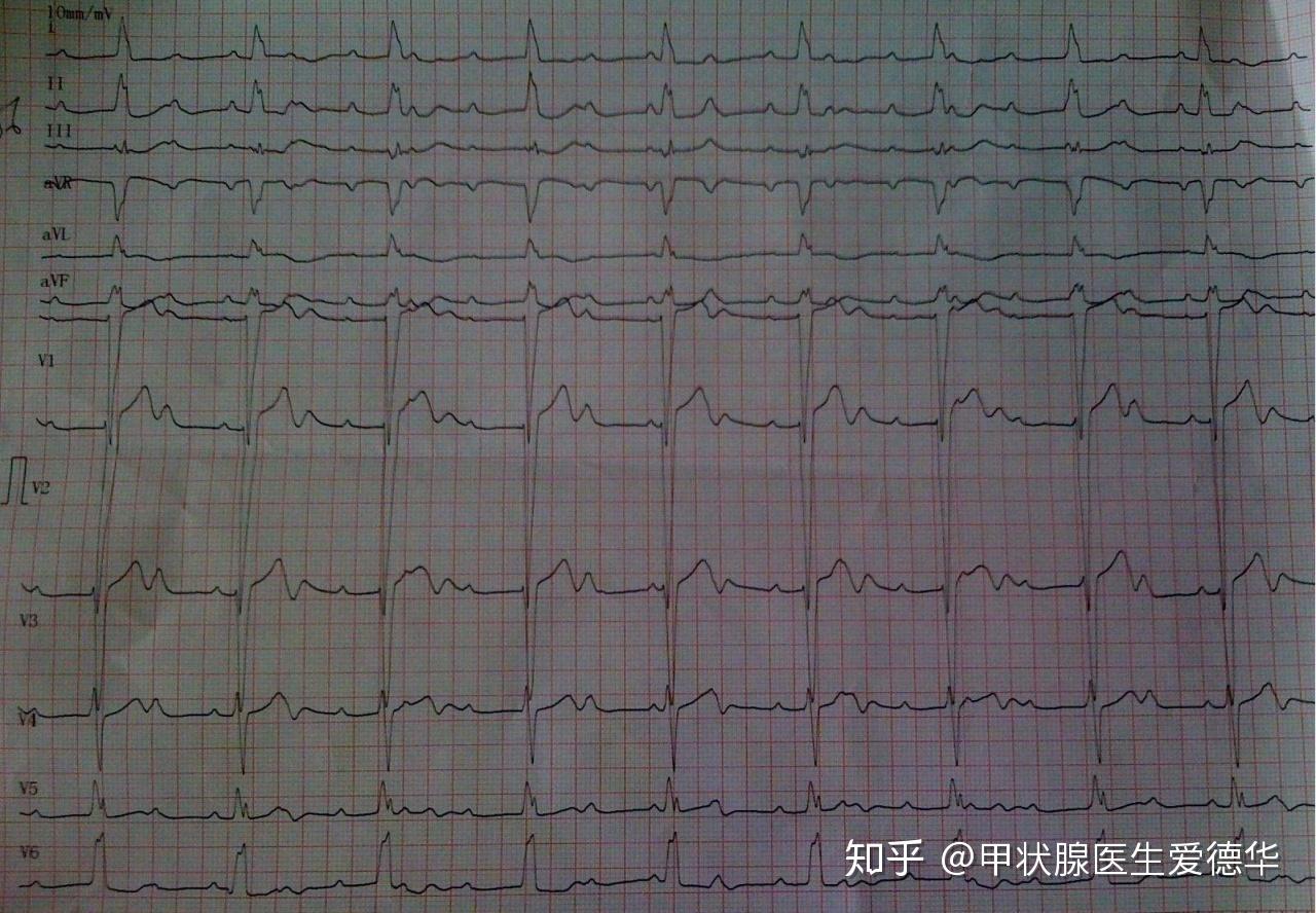 得了心肌炎,都應該做哪些檢查呢:01 體格檢查——心肌炎的患者,聽診