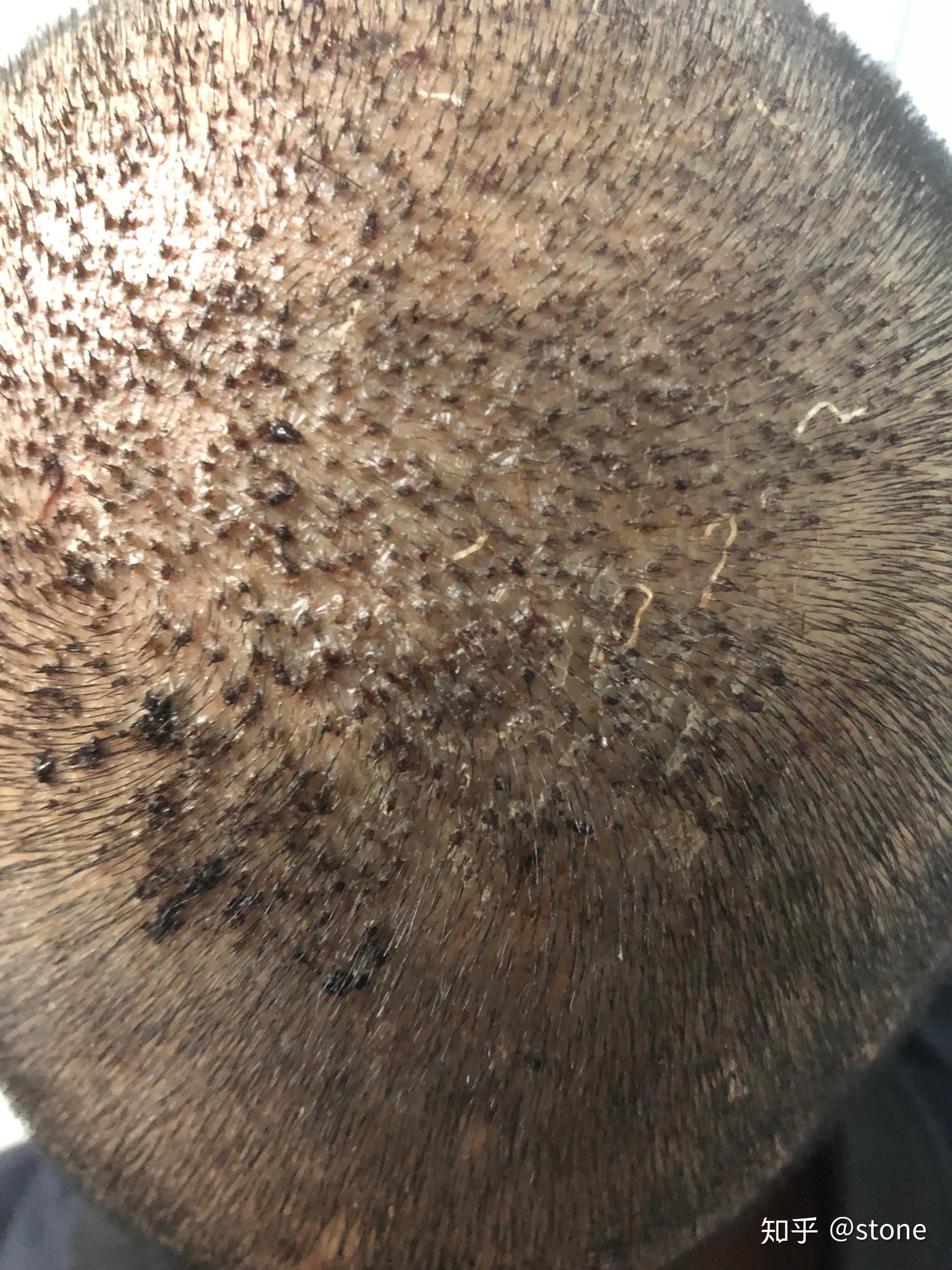 植发会有鬼吗(植发会不会死人)