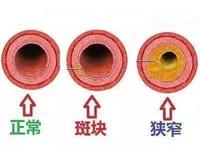 簡單易掌握的tia頸內椎基底動脈解剖