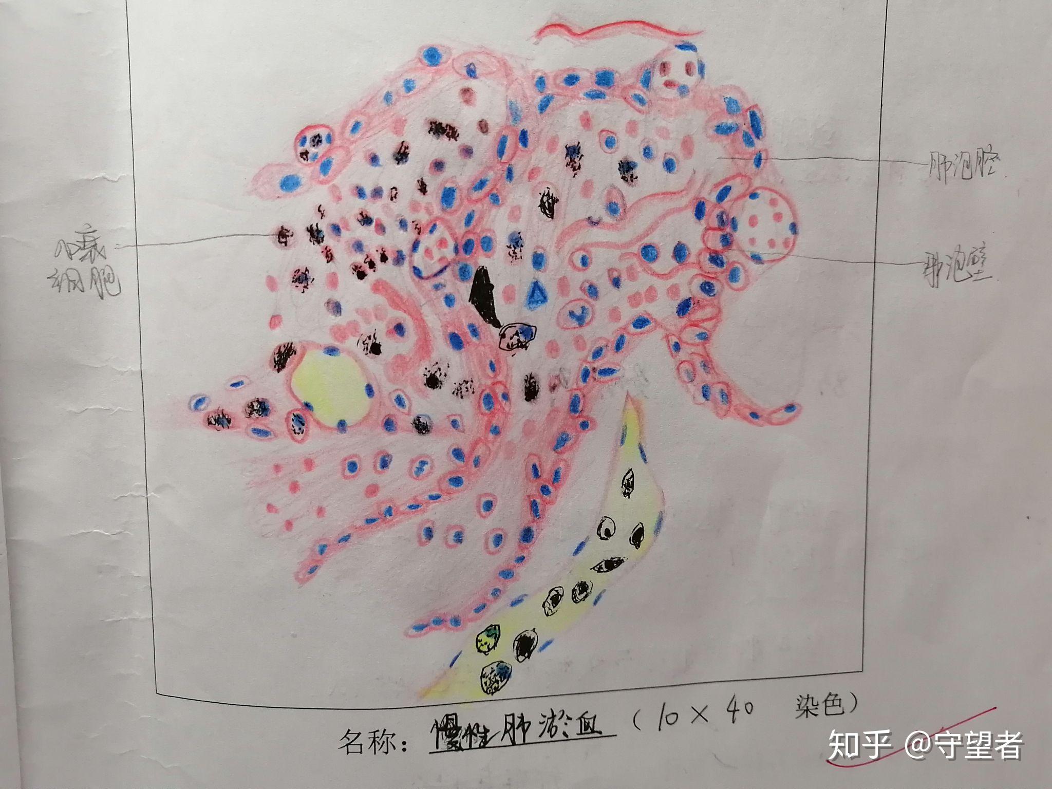 9.0 注意胞漿顏色紅色9.0 注意細胞異型性9.