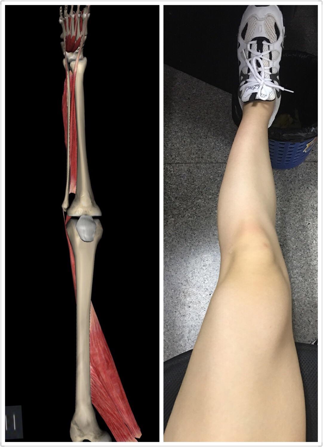 x 型腿怎么治疗 v2-8edfd6a86be485fd3afaf98686c88f66_r.jpg