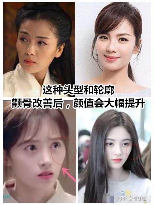重庆时光整形头型长这样的颧骨内推要注意了