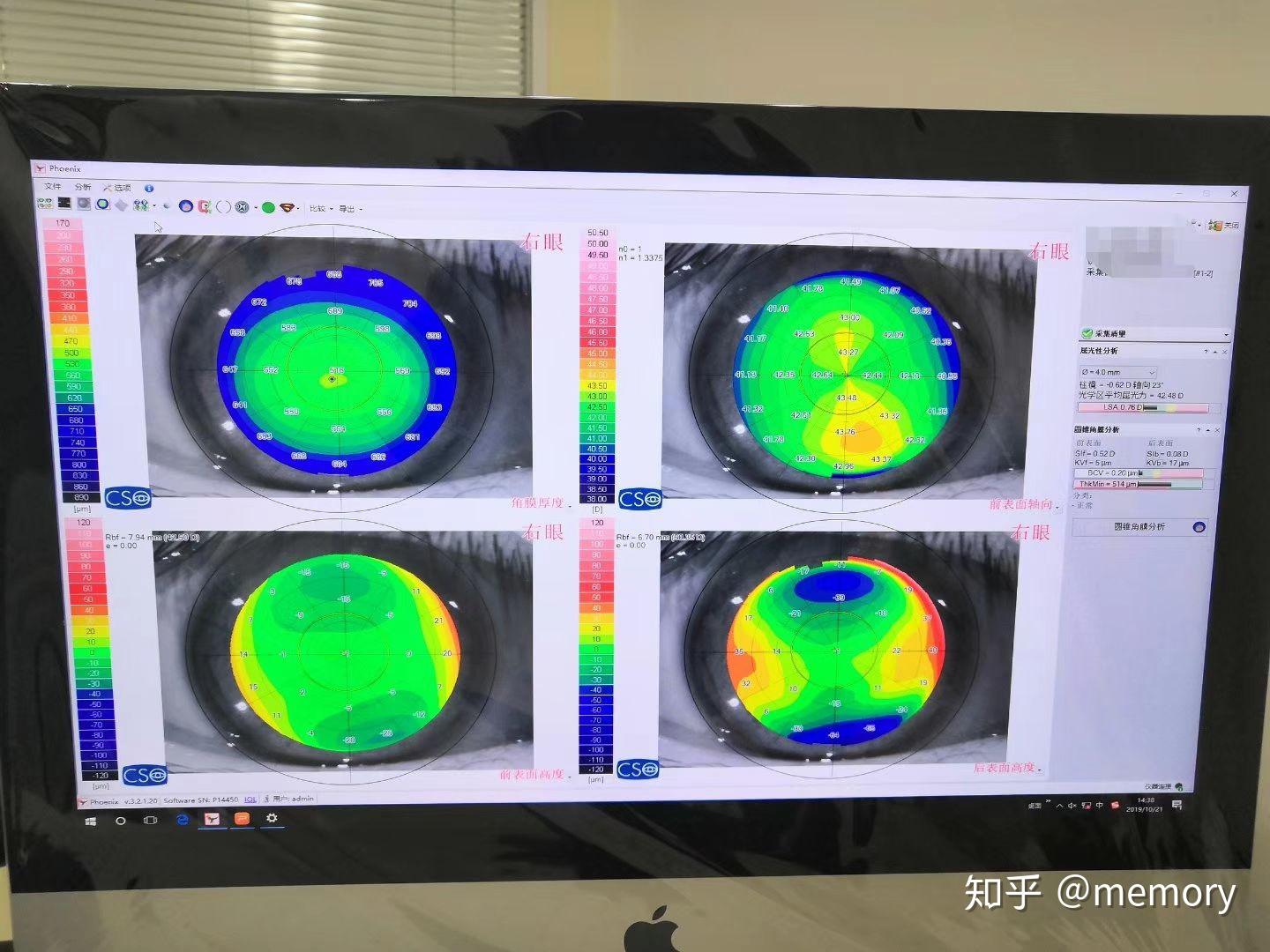 近视手术术后分享