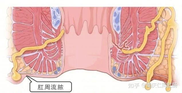 屁股有膿包是不是患了肛周膿腫重慶仁同肛腸醫院有限公司