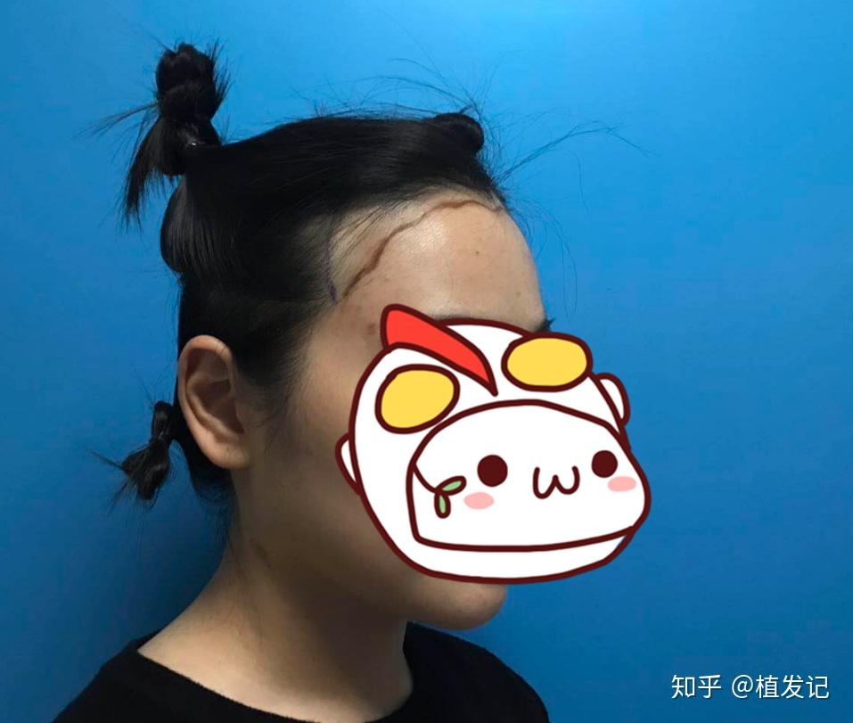 天生脑门宽的人真的就没办法改变了吗？ - 知乎