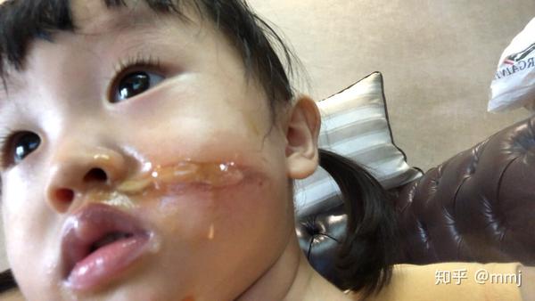 记录宝宝脸部二度烫伤恢复过程 面部一度烫伤图片 黄田网