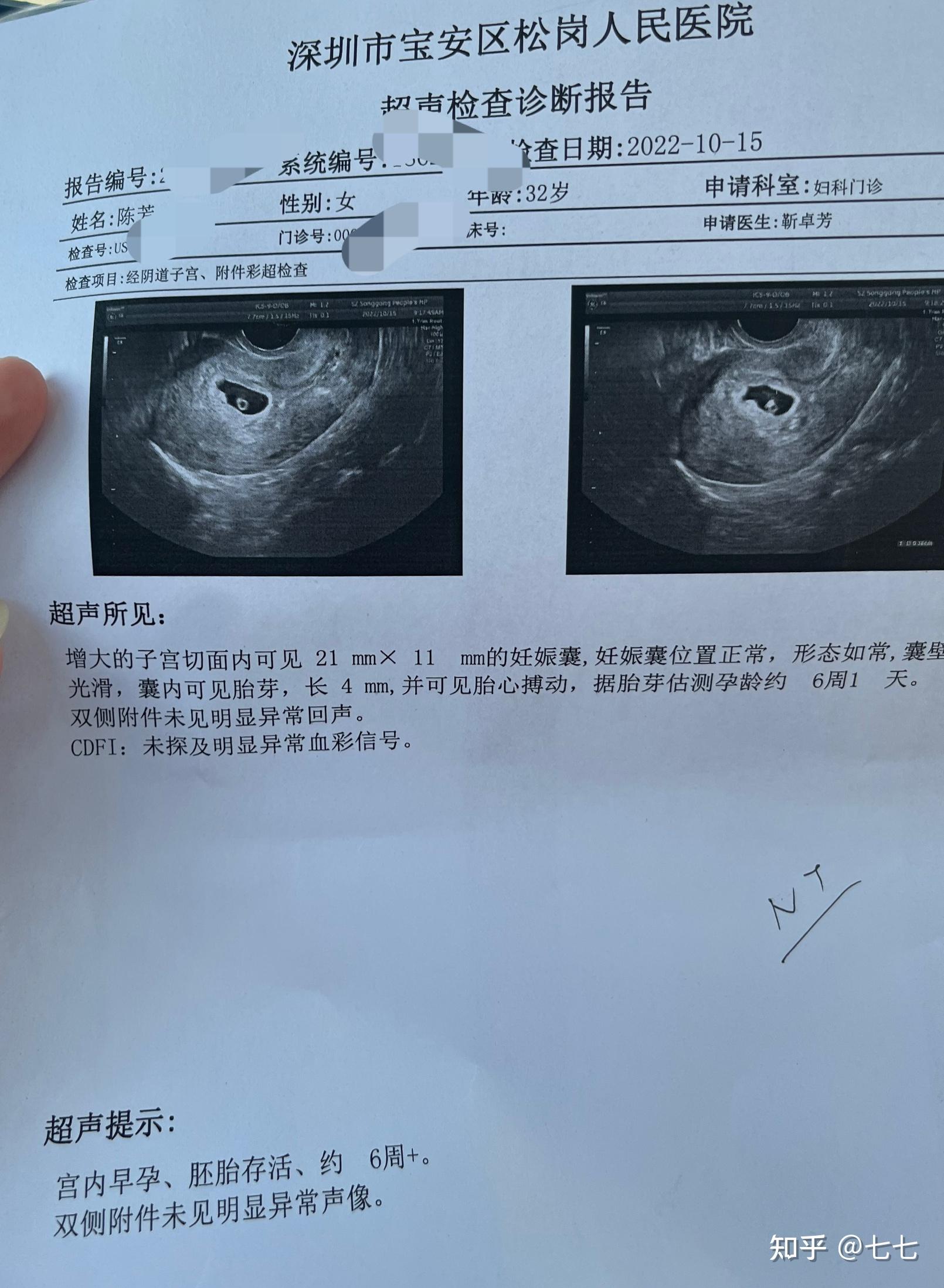 怀孕10周胚胎停育自然流产残留全过程