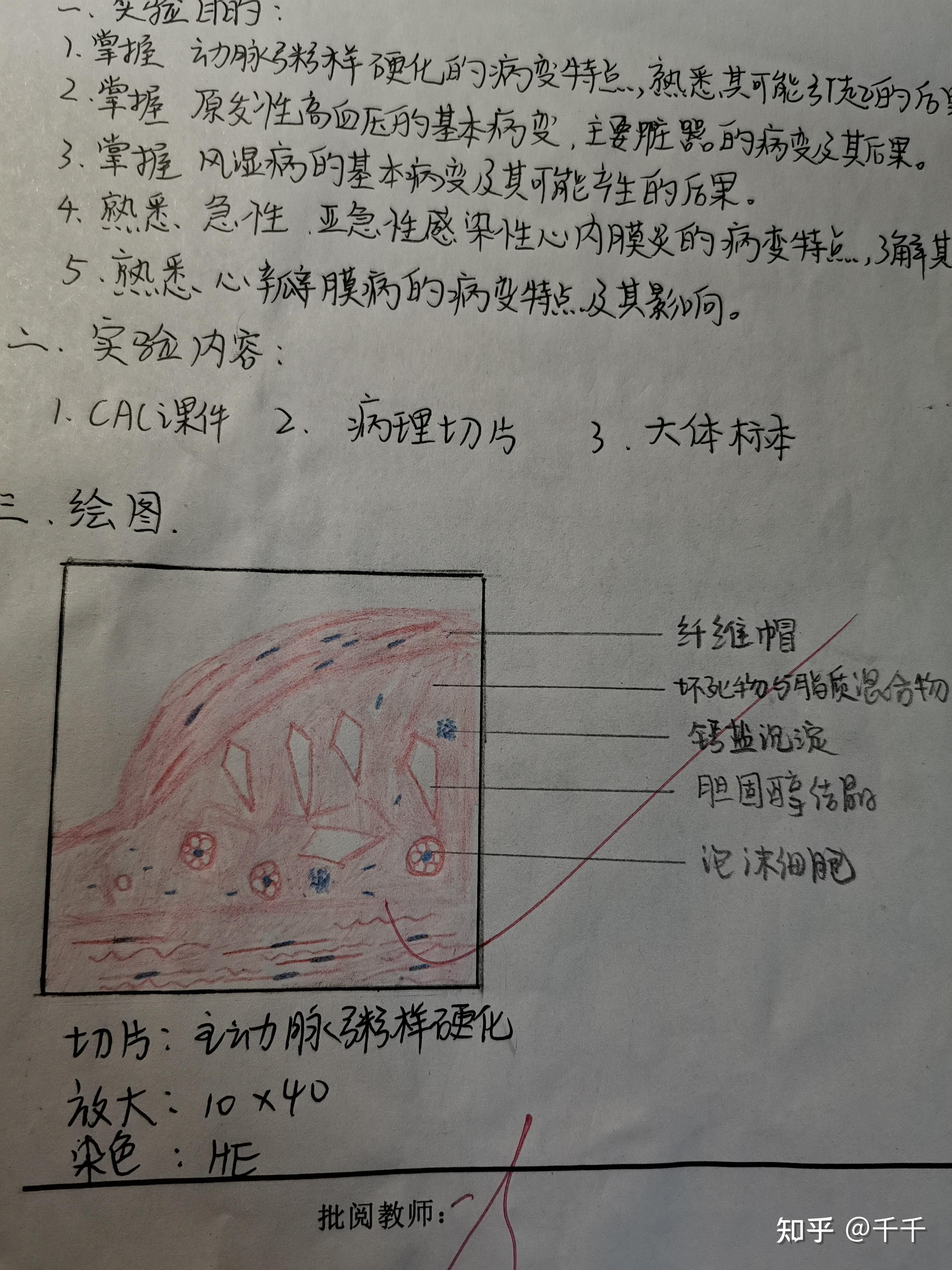 門脈性肝硬化8.急性瀰漫性增生性腎小球腎炎9.結核病