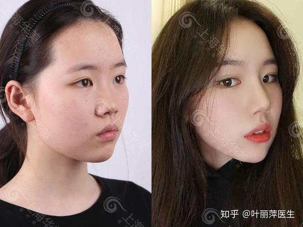 鼻子塌的女生怎样由丑变美 - 知乎