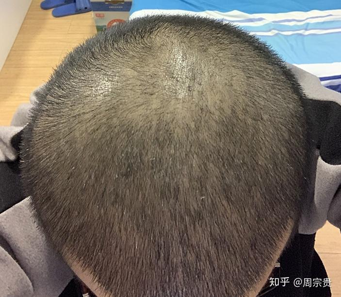 当四级脱发遇上毛囊资源受限术后4个月效果竟然