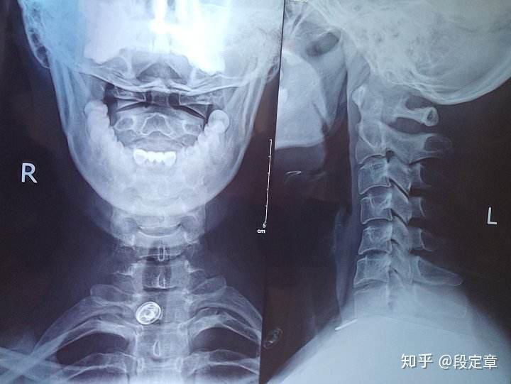 颈项你要知道的那些事儿