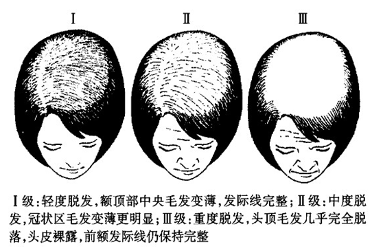 发缝宽的人应该如何自救? - 知乎