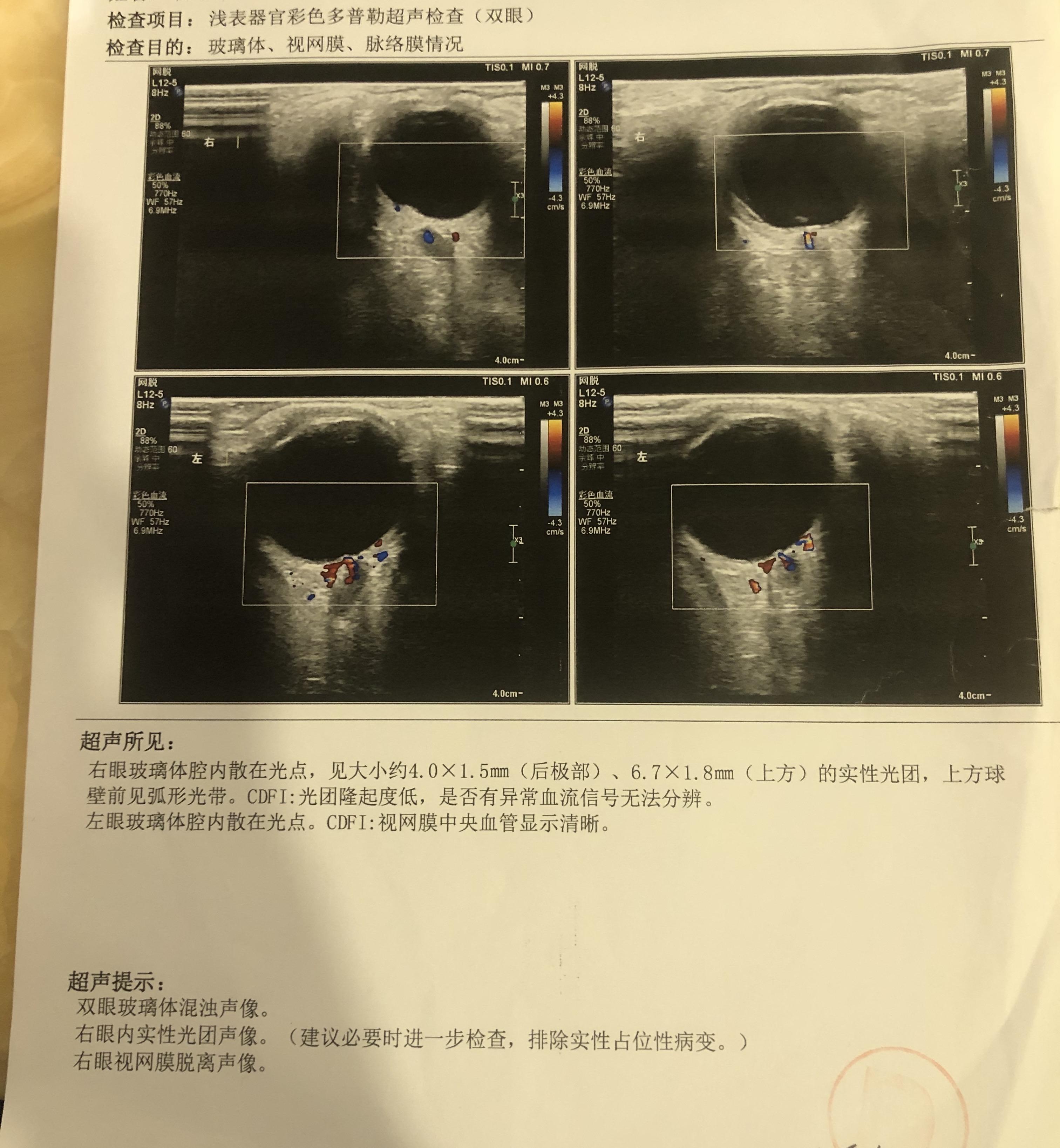 脉络膜脱离超声图图片