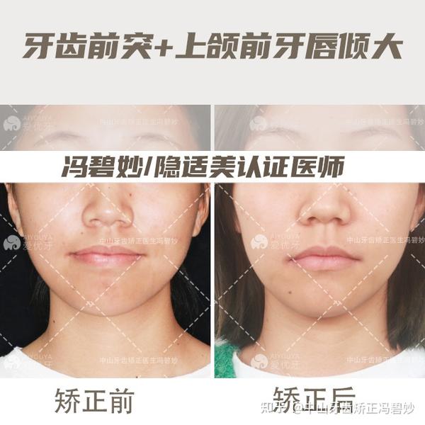 #中山牙齿矫正:前牙唇倾度大,正畸实现侧貌协调美观 - 知乎