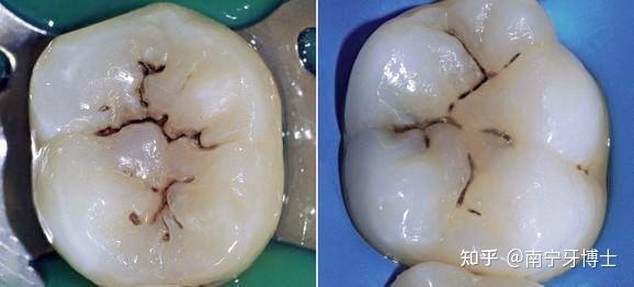 牙齿上的黑线怎么刷都刷不掉那可能是窝沟龋