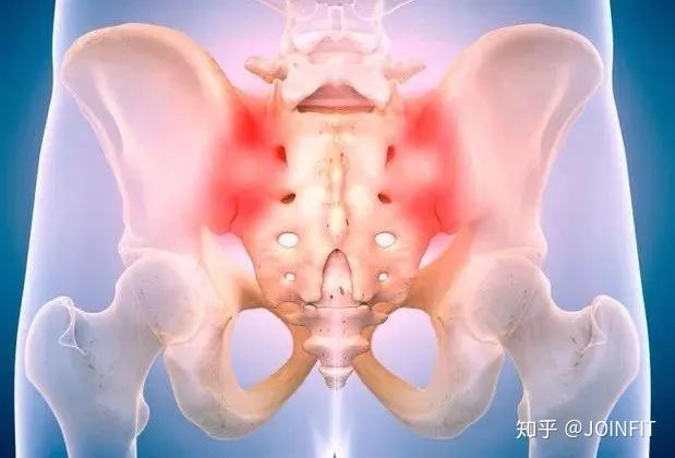 腰痛之骶髂关节疼痛的原因及运动恢复