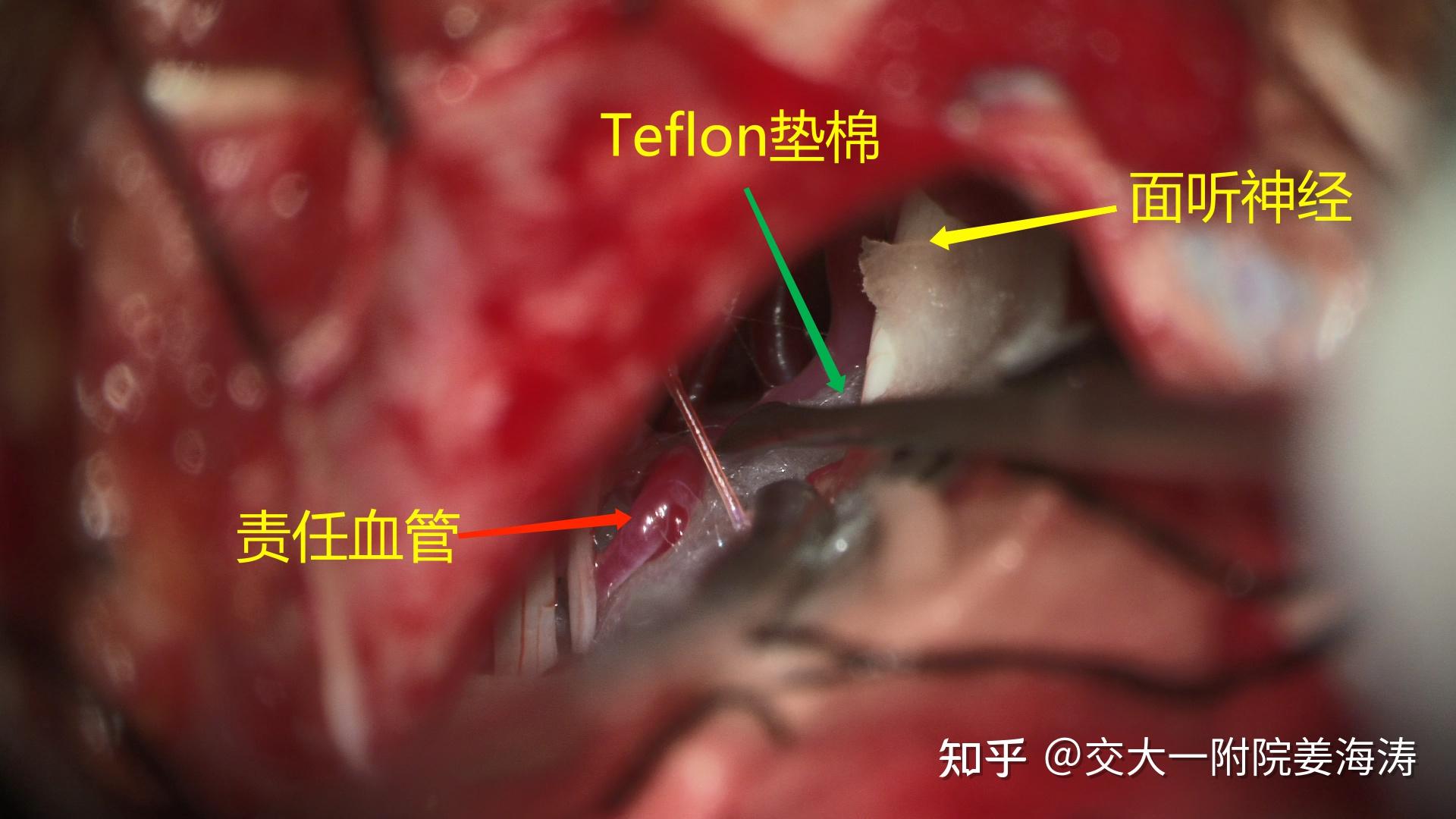 确保面听神经及血管不损伤