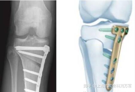 胫骨高位截骨术 Hto 患者常见问题解答 知乎