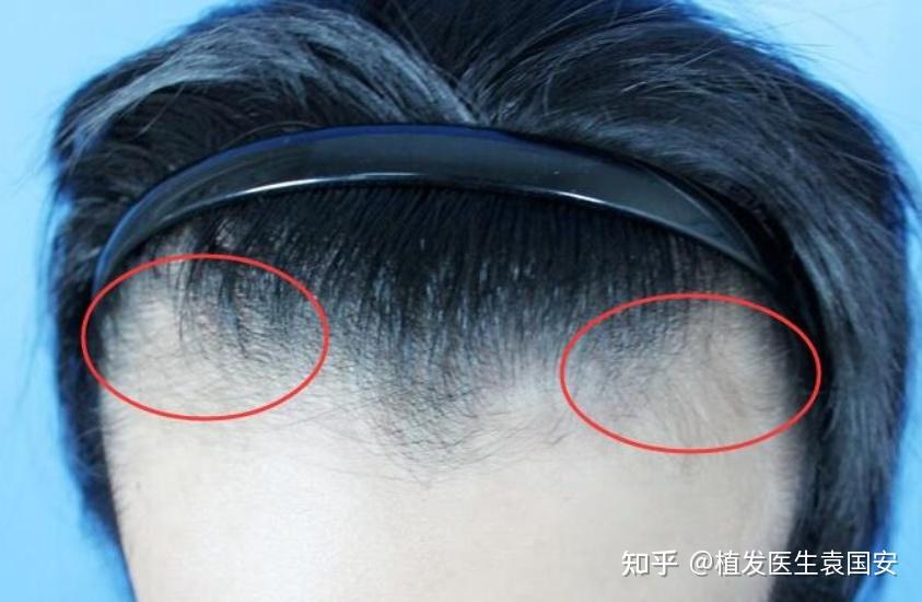 M型脱发能自己恢复吗? - 知乎