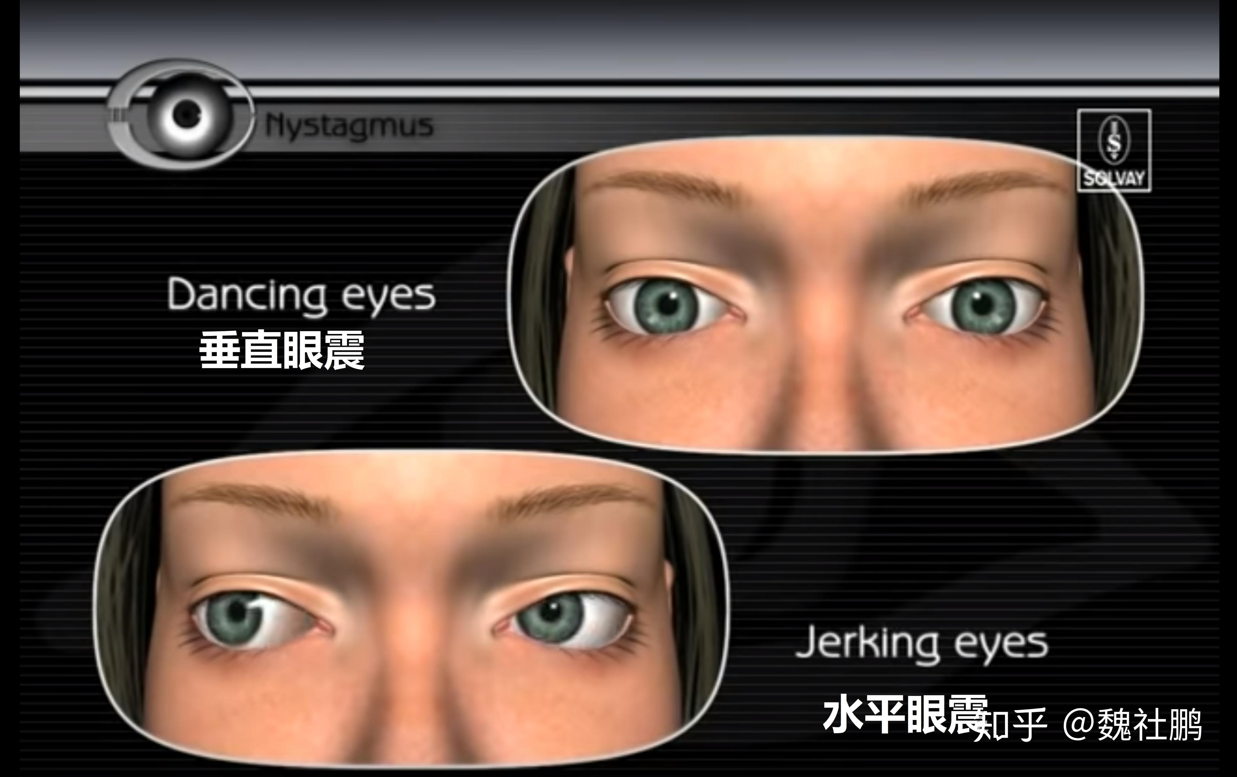 "眼球震颤"的特征:类型(水平,扭转,垂直),采用凝视去压制的倾向,以及"