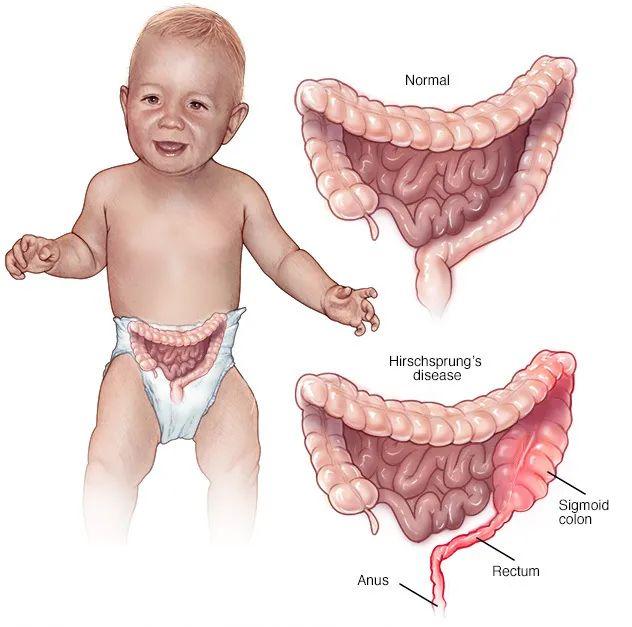 巨结肠宝宝的症状图片图片
